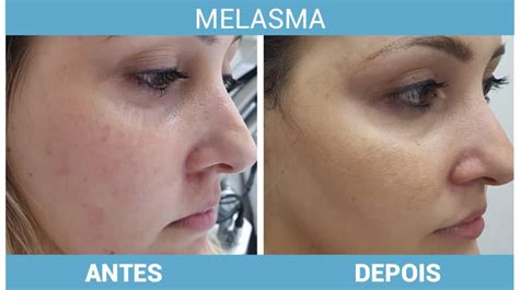 Vitamina C Melasma Antes E Depois - Melasma - Veja O Antes E Depois Dos Tratamentos Mais Eficazes - O ...
