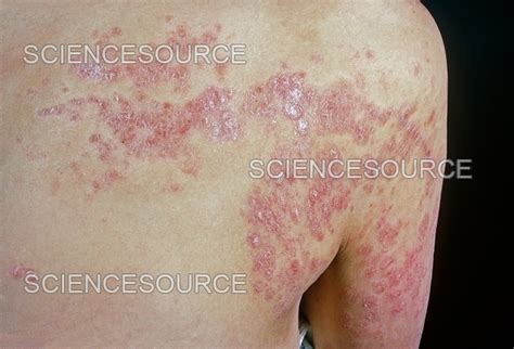 Photograph Pustular Psoriasis Science Source Images