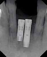 Dental Implant Infection