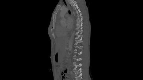 Chest Ct Sagittal View Of Sternal Fracture Youtube