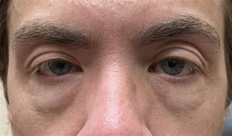 34 Eyelid Surgery Before And After Photos Dallas Plano Texas Cosmetic Reconstructive Eye Surgery