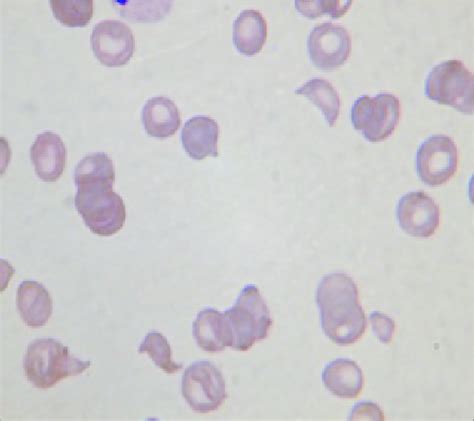 Schizocytes on peripheral smear. | Download Scientific Diagram