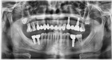 Implantes dentales Complicaciones Clinica Dental Larrañaga