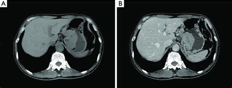 Ees In The Stomach A Unenhanced Ct Image Shows An Irregular