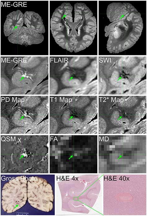 Frontiers Neuropathology Of Pediatric Sars Cov Infection In The