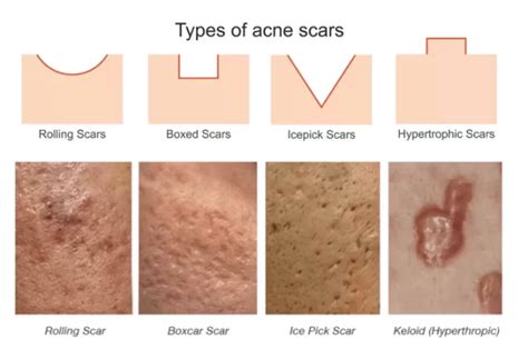 Icepick Scar Treatments In Edmonton at Albany Laser Centre