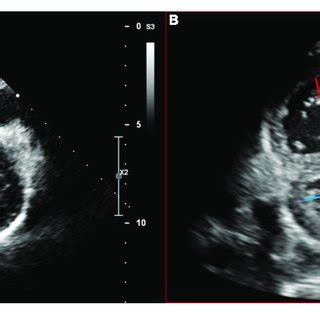 Echocardiographic Measurement Of The Right Ventricular To Left The