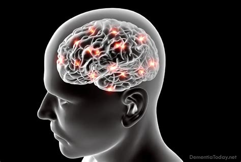 Two Alzheimer’s risk genes linked to brain atrophy, promise future ...