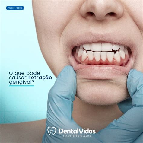 Pessoas Que Apresentam Dentes Restaura Es Met Licas Ensino