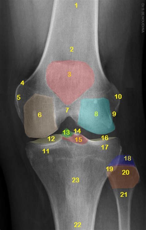 Normal Radiographic Anatomy Of The Knee 1 Femoral Shaft 2 Distal