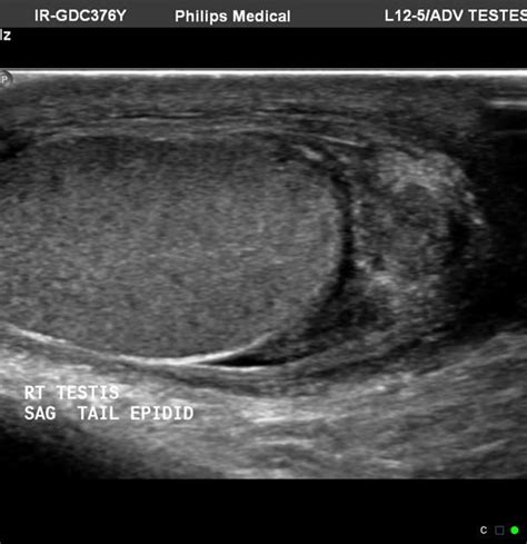 Testicular Ultrasound Epididymis