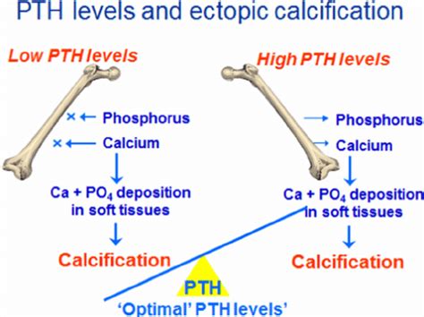 Levels Of Parathyroid Hormone PTH And Ectopic Calcification PO 4