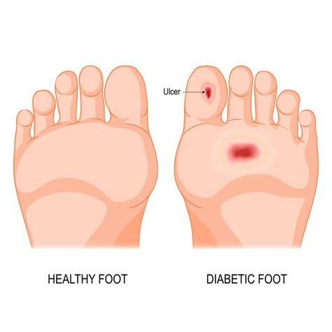 Diabetic Foot Care — Podiatrycare Pc And The Heel Pain Center