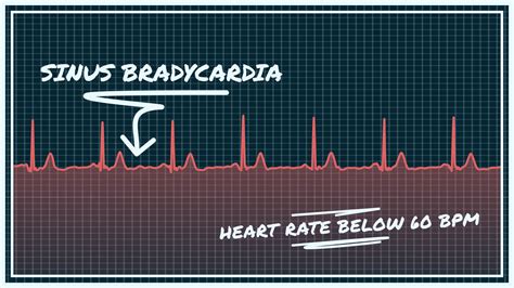 What Sinus Bradycardia Looks Like on Your Watch ECG | Qaly