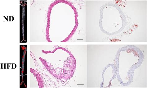 Atherosclerotic Lesion Formation In Hfd Treated Apoe Ko Mice