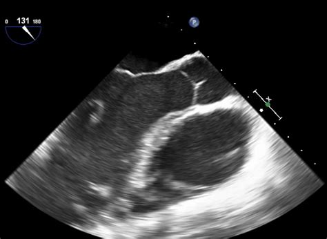 Aortic Stenosis a Tight Aortic Valve – A Comprehensive Patient Guide ...