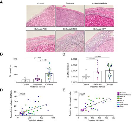 Glissons Capsule Matrix Structure And Function Is Altered In Patients