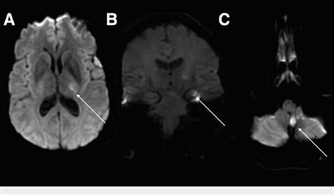 Magnetic Resonance Imaging Mri Demonstrating Acute Infarct Axial