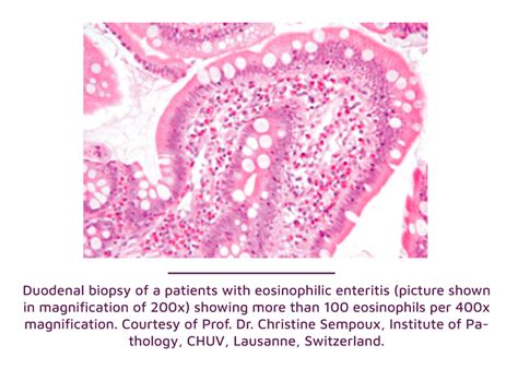 SNEGID - Eosinophilic gastritis, eosinophilic enteritis, and ...