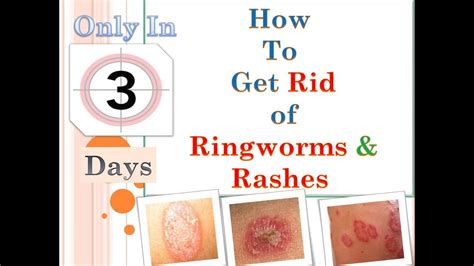 Ringworms Ii How To Get Rid Of Ringworms Youtube