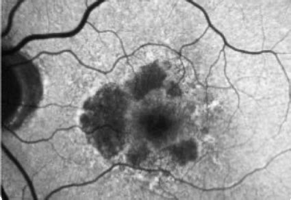 Geographic Atrophy How To Diagnose Ga When To Refer