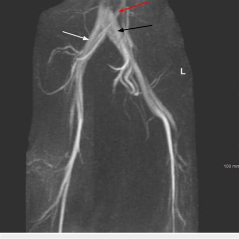 Magnetic Resonance Venography Of The Pelvic Vasculature Demonstrating