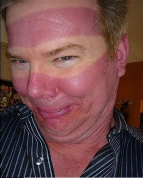 The 12 Worst Sunburns In History