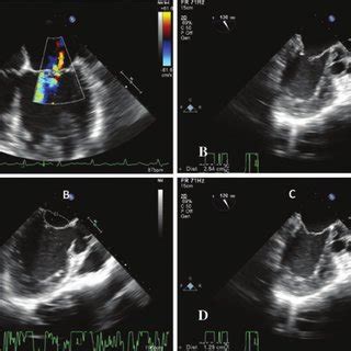 Mid Esophageal Long Axis View Illustrating Asymmetric Dilatation Of The