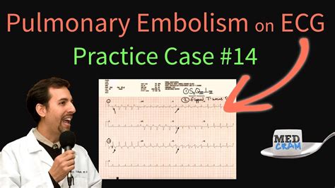 Ecg Findings In Pulmonary Embolism Ekg Changes With An Acute Pe Youtube