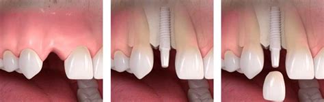 IMPLANTES DE ZIRCONIA Clinica Dental Fabián López