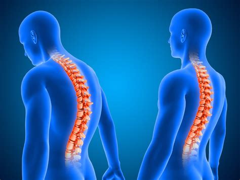 Scoliosis Vs Kyphosis Key Differences Total Orthocare