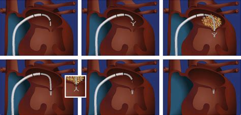 Figure 1 From Percutaneous Repair Of Mitral Regurgitation With The