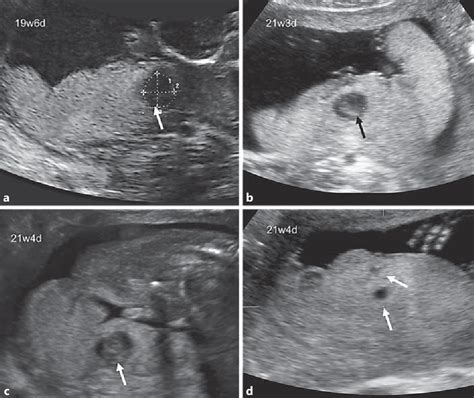 Pdf Prenatal Diagnosis Of A Placental Infarction Hematoma Associated