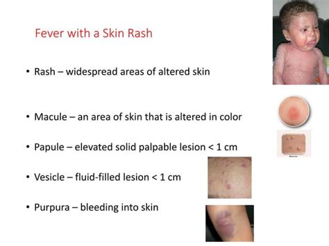 Fever With Vesicular Skin Rash In Children 2021 Ppt