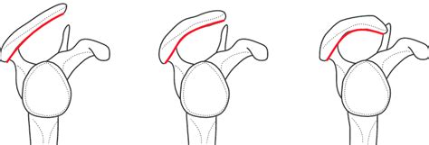 The Three Different Structural Types Of Acromion Download Scientific