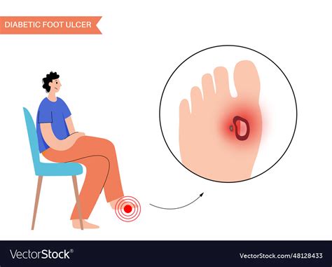 Diabetic foot ulcers Royalty Free Vector Image