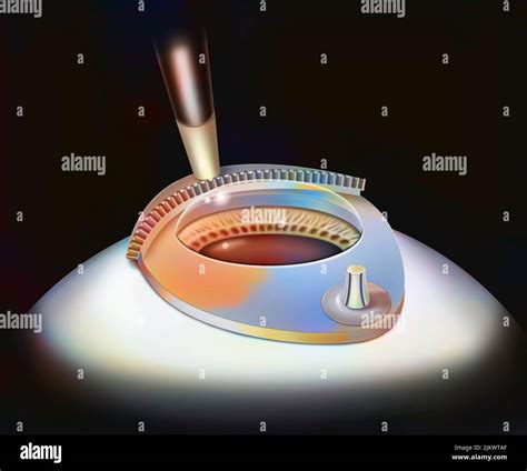 Eye Surgery Lasik Step 1 The Microrobot Is Guided By A Suction Ring