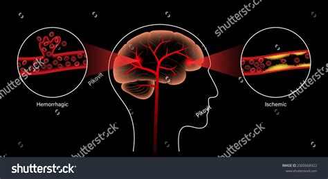 Brain Stroke Hemorrhagic Ischemic Problem Arteriosclerosis