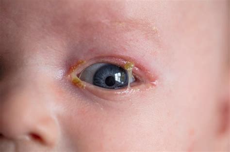 Neonatal Conjunctivitis Causes Symptoms And Treatment