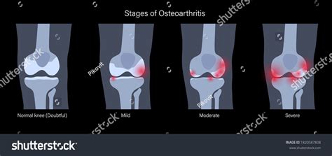 X Ray Stages Osteoarthritis Knee Joint Stock Vector (Royalty Free) 1820587808