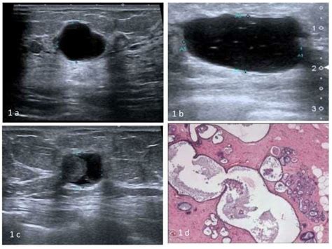 1a: Ultrasound showing clear cyst with posterior acoustic enhancement ...