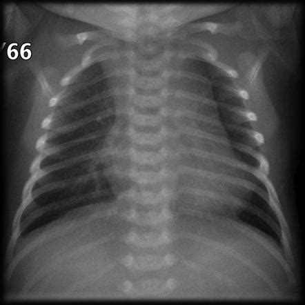 Thymus Radiology Reference Article Radiopaedia Org