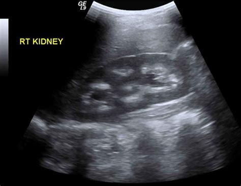 Nephrocalcinosis Definition Types Causes Symptoms Diagnosis And Treatment