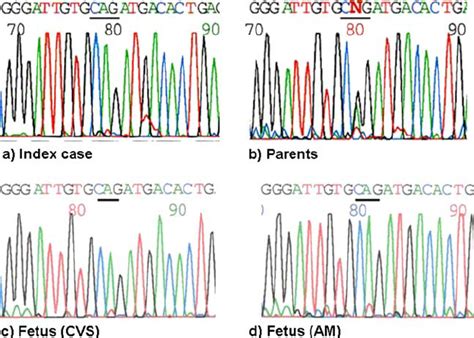 Sequences Of The Exon Of The Clcn In Index Case The Parents And