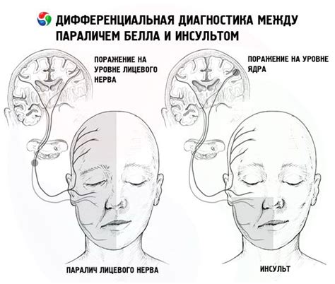 Паралич лицевого нерва фото до и после лечения