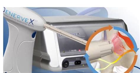 Medovex Corporation Presents Initial Data on the DenerveX® System ...