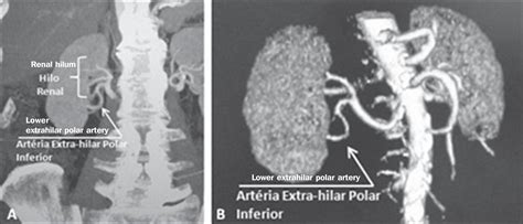 Scielo Brasil Multidetector Computed Tomography Angiography Of The