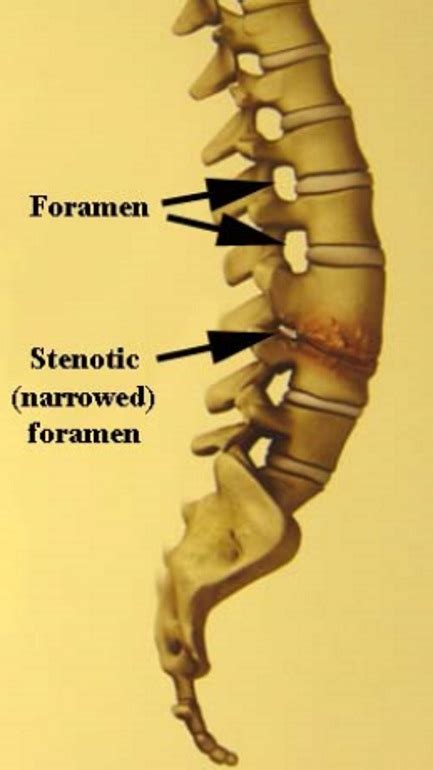 Foraminal Stenosis Drwolgin Hot Sex Picture