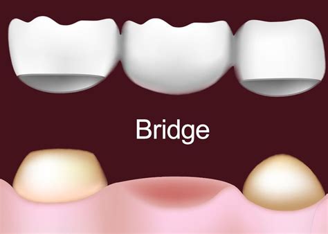 Dental Bridges – Lakeville, NY - Lakeview Dental - Dr. Hirschfield