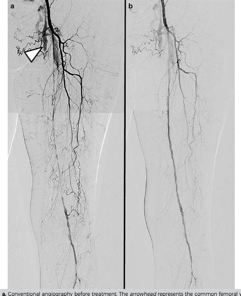 Figure 4 From Complex Combination Of Femoropopliteal Occlusive Disease